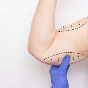 Criolipolisis plana Brazos + 4 sesiones aparatologia